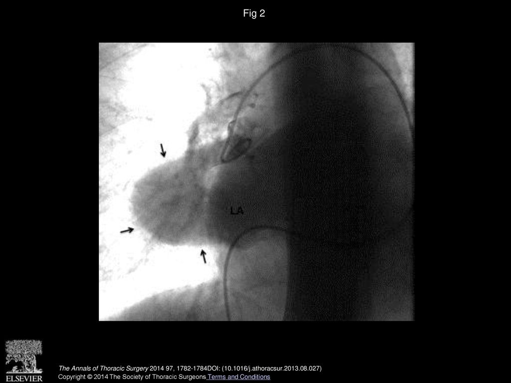 Fig 2 Injection of right pulmonary artery during conventional angiography. Arrows show the aneurysm. (LA = left atrium.)