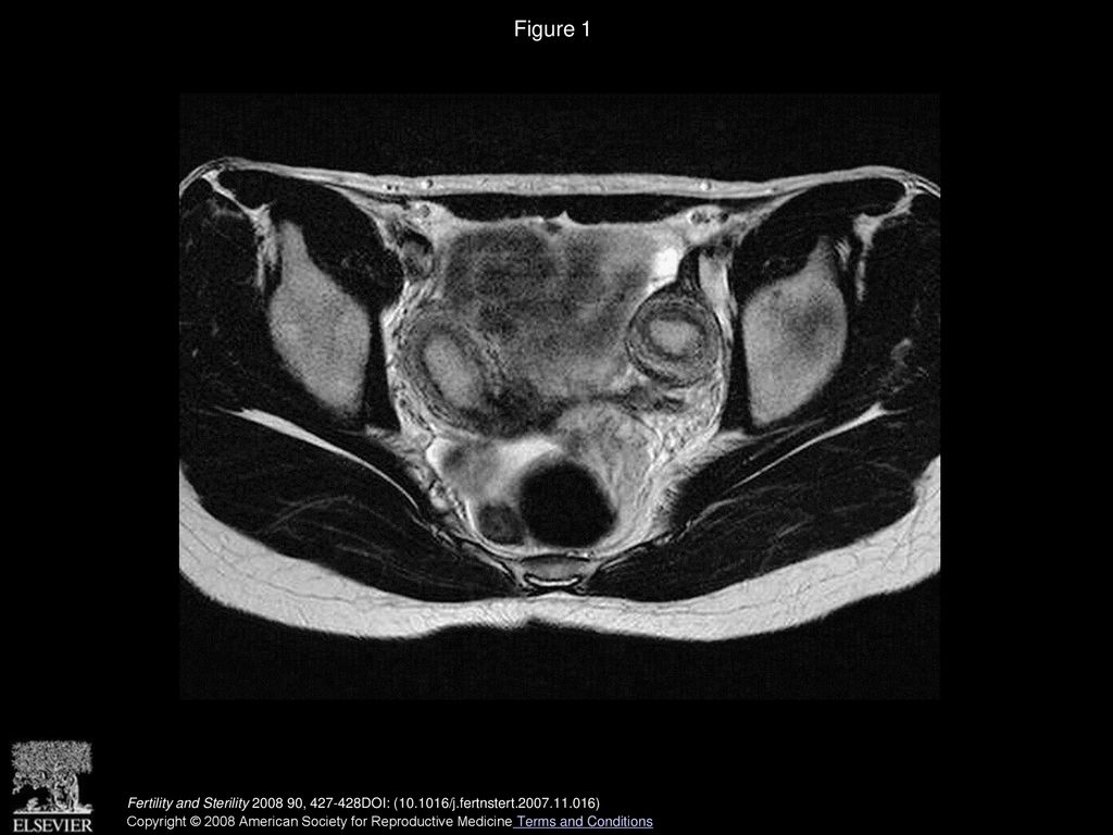 Figure 1 Magnetic resonance imaging (T2-weighted image): uterus didelphys without hematometra.