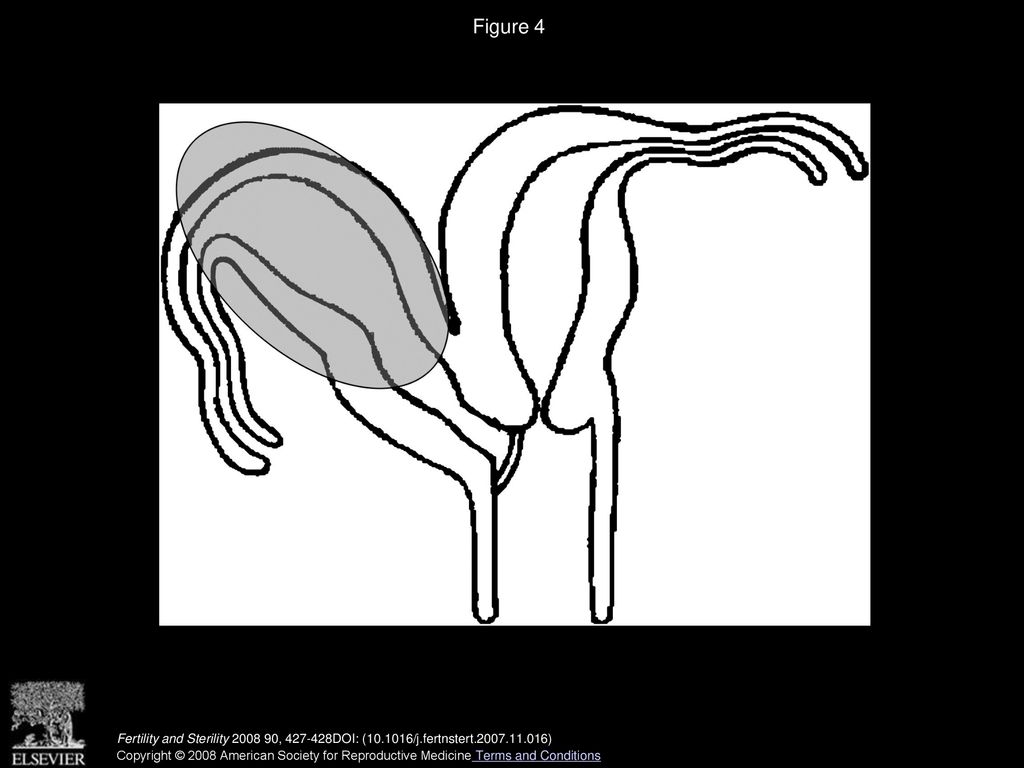 Figure 4 Uterus didelphys with an affected uterus in the retroperitoneum.