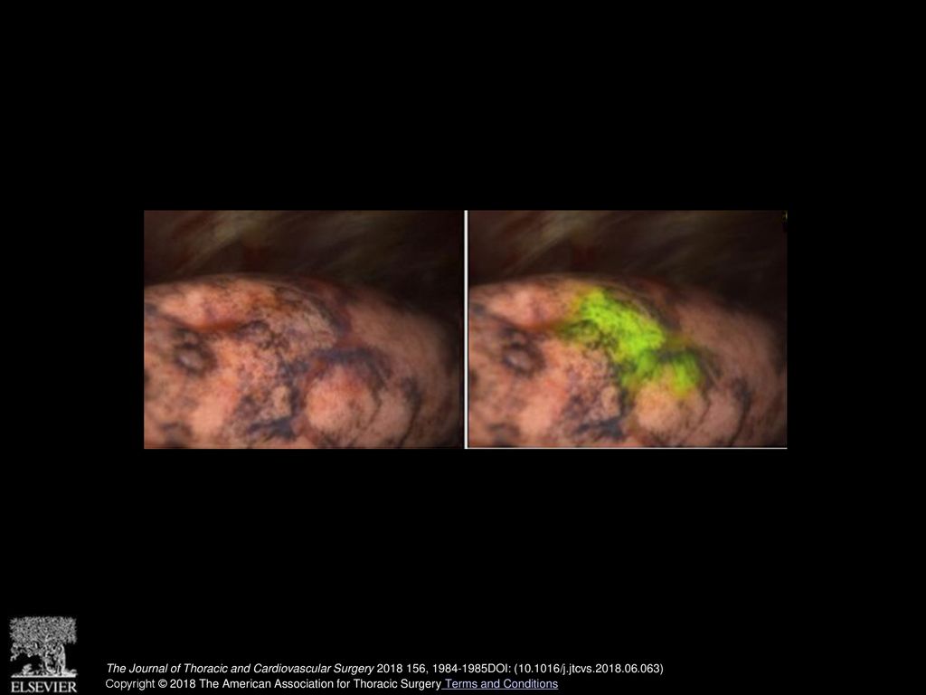 Identification of a lung tumor by near infrared fluoroscopy.