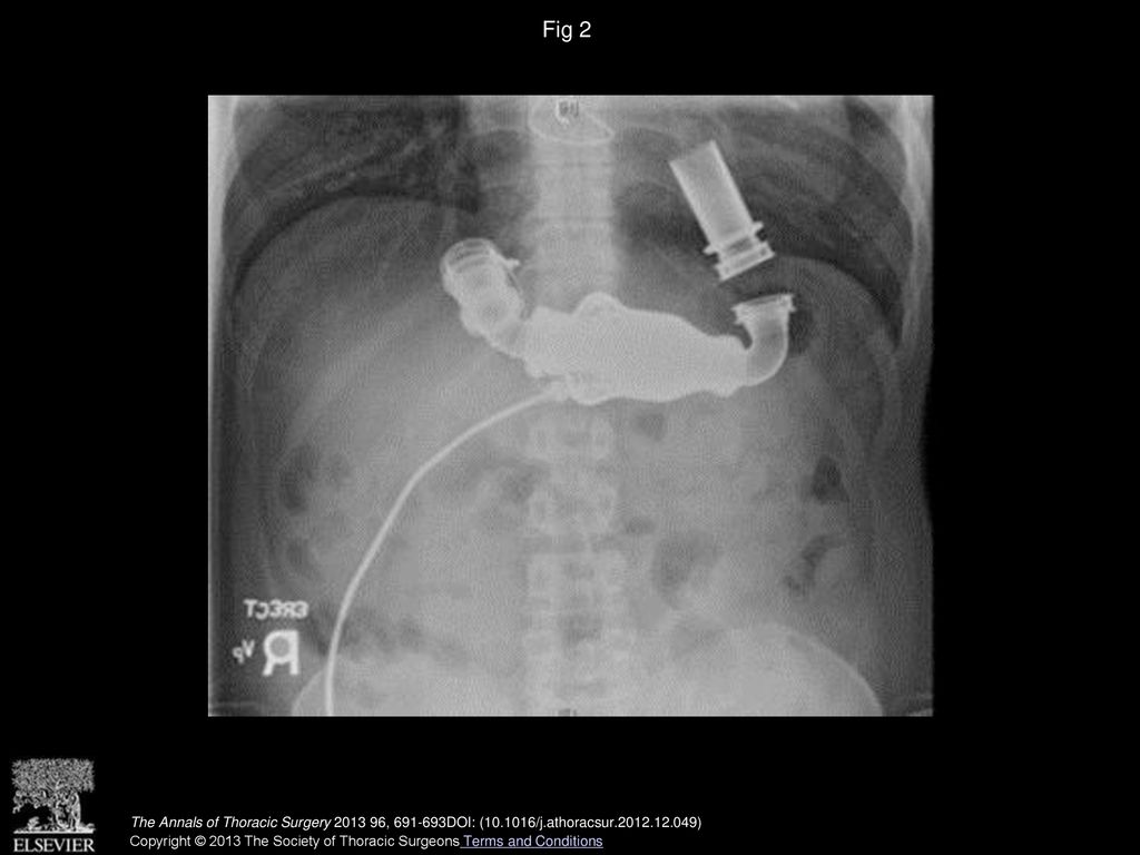 Fig 2 Postoperative chest x-ray film showing position of the inflow cannula in the left lateral portion of the right ventricular apex.