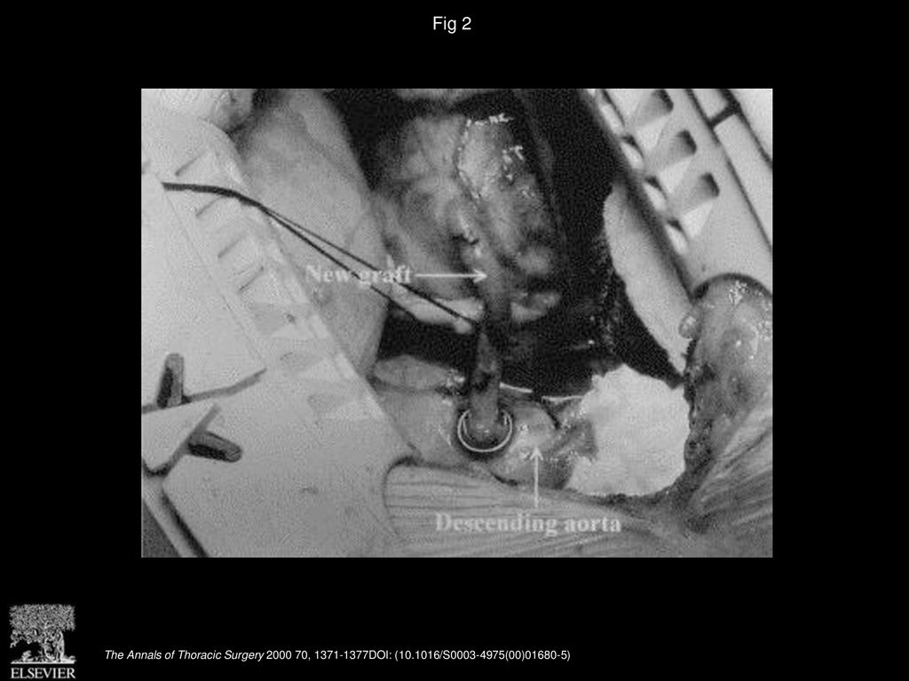 Fig 2 Completion of anastomosis between the graft and the descending thoracic aorta.