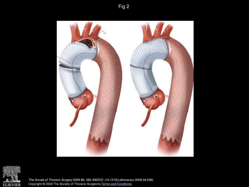 Fig 2 Proximal and distal anastomoses of Dacron arch graft.