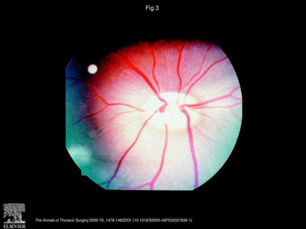 Fig 3 Fundus photography before operation shows the branches of the central retinal artery and central retinal vein.