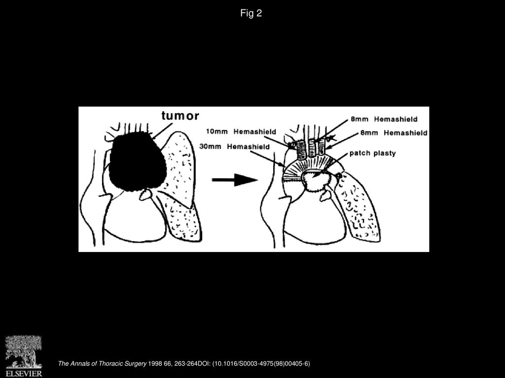 Fig 2 Location of invasive thymoma and reconstruction of the aortic arch and main pulmonary artery.