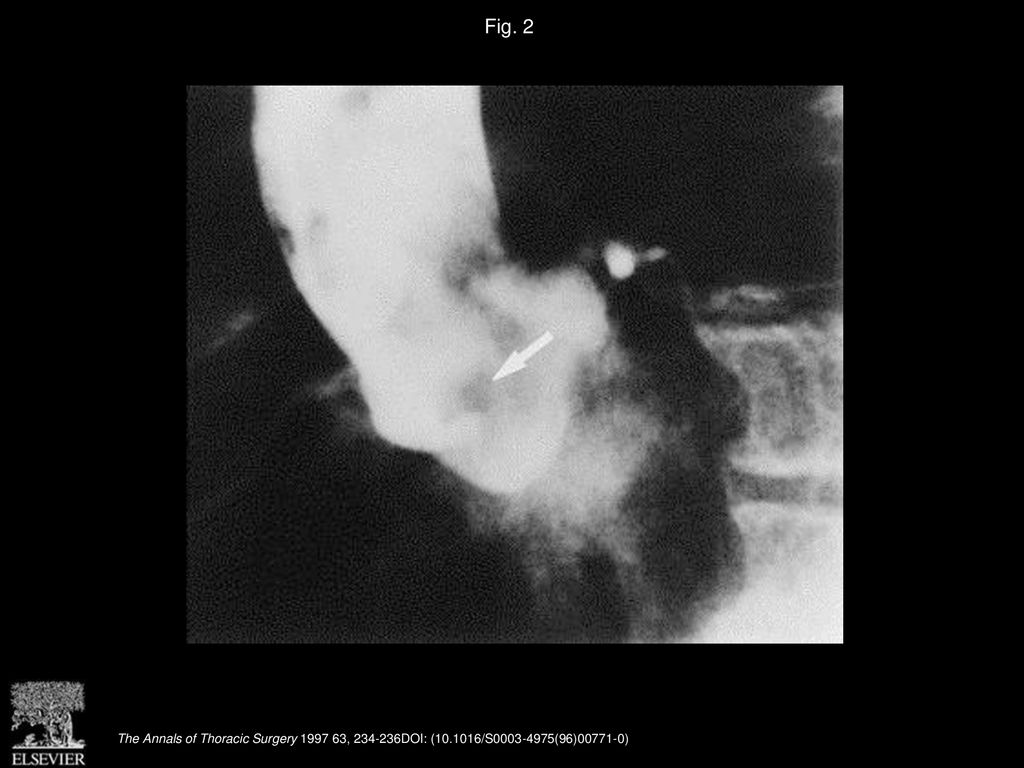 Fig. 2 Aortic root cineangiogram in systole demonstrating that the mass (arrow) is mobile and related to the aortic cusp motion.