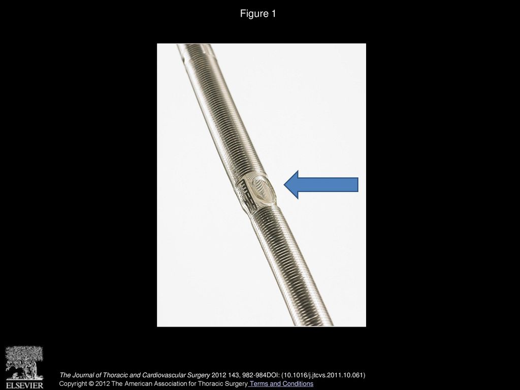 Figure 1 A dual lumen ECMO catheter with a right atrial infusion port (blue arrow).