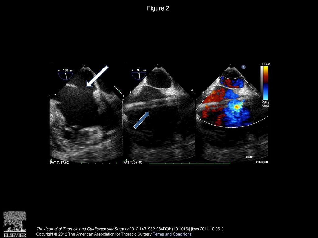 Figure 2 The right atrial infusion port (blue arrow) shunts oxygenated blood across the ASD (white arrow).