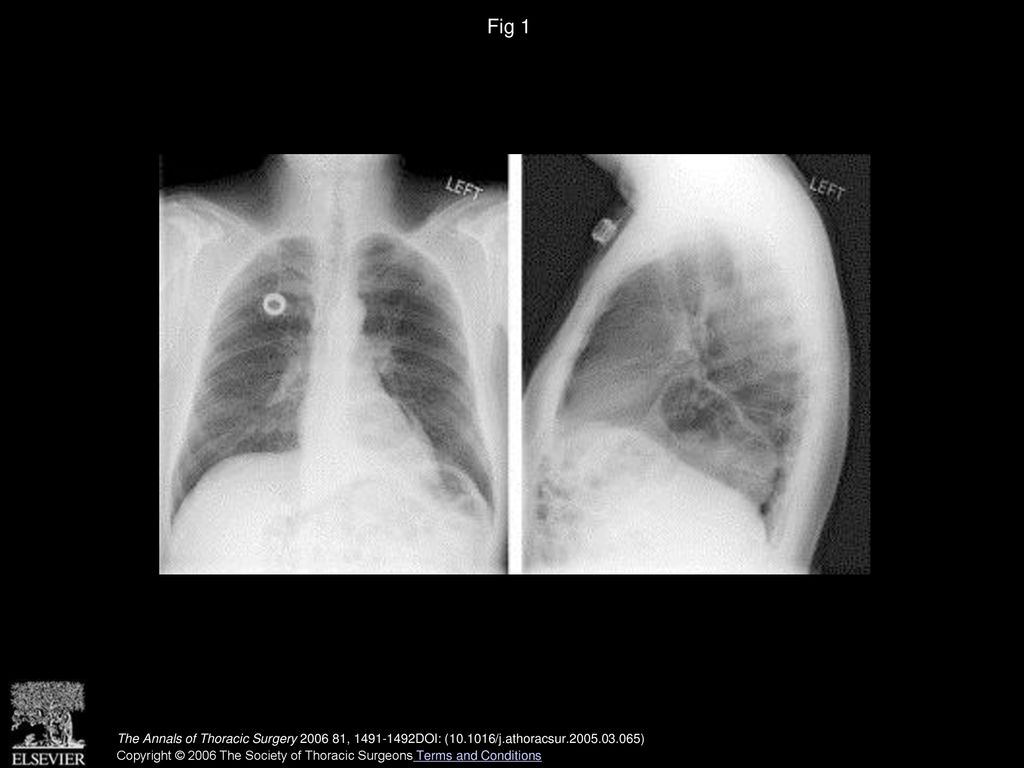 Fig 1 Preoperative chest roentgenograms (PA and lateral) showing a large hiatal hernia.
