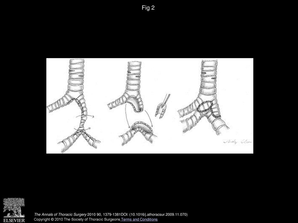 Fig 2 Operative technique of the combined slide tracheoplasty and tracheal autograft technique (see text for details).