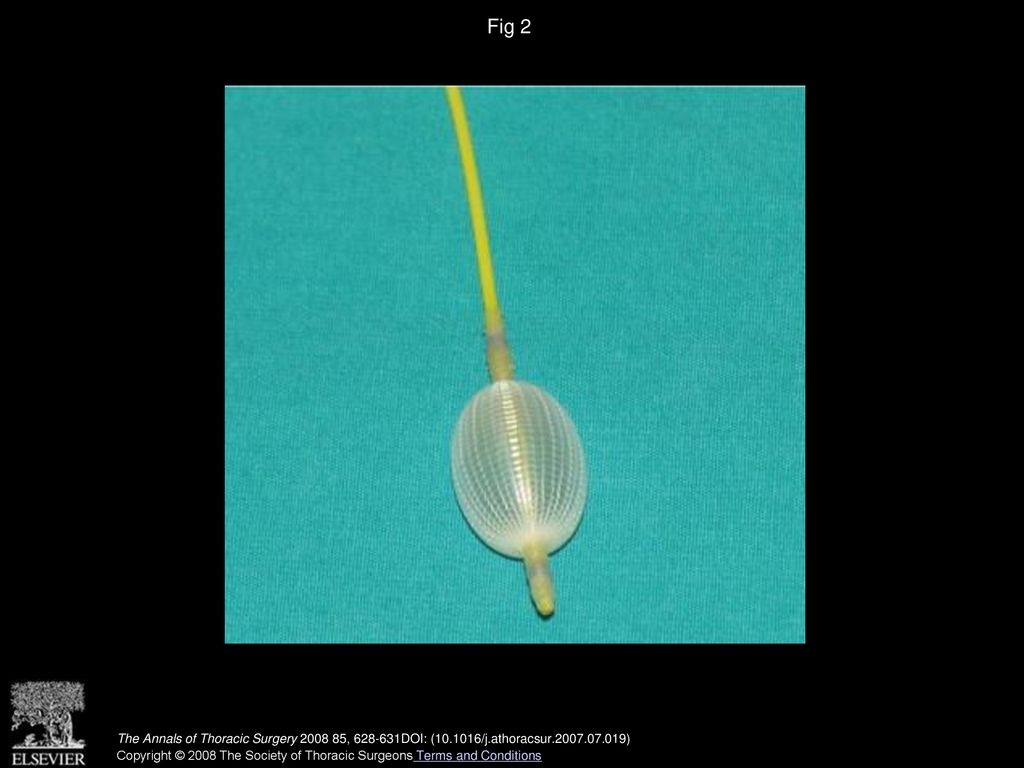 Fig 2 Resector balloon. Special structure is seen when inflated.