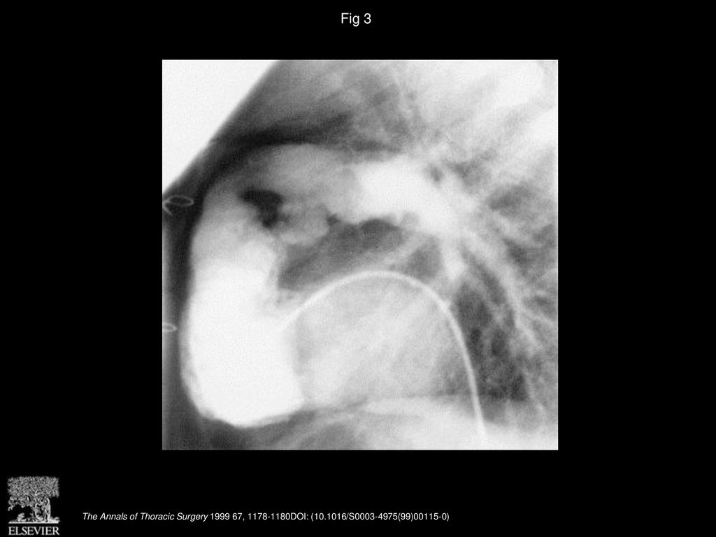 Fig 3 Postoperative angiocardiographic frame showing double outflow from the right ventricle to the branch pulmonary arteries.