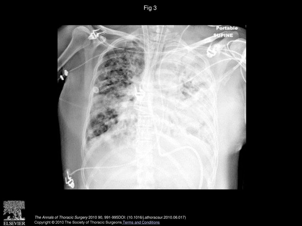 Fig 3 Chest roentgenogram revealing cannula displacement into right atrium.