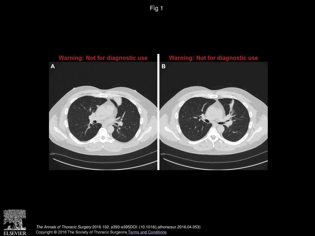 Fig 1 Representative computed tomographic axial images demonstrating left upper lobe inflammatory mass.