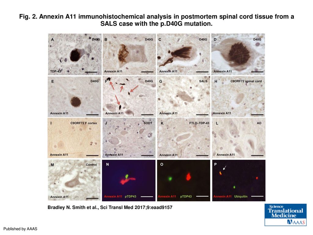 Fig. 2. Annexin A11 immunohistochemical analysis in postmortem spinal cord tissue from a SALS case with the p.D40G mutation.