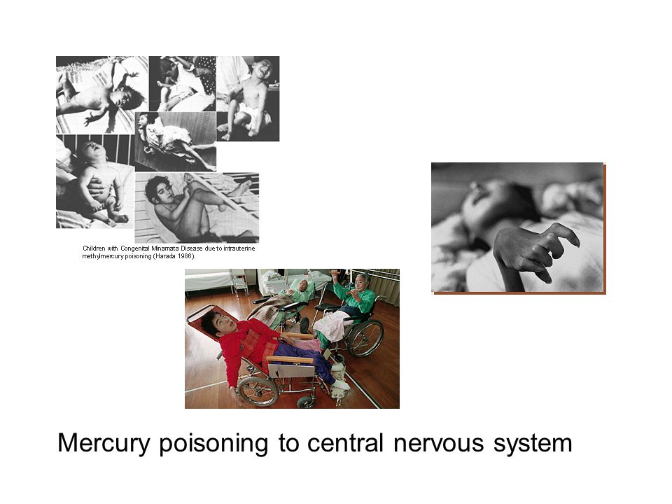 Mercury poisoning to central nervous system