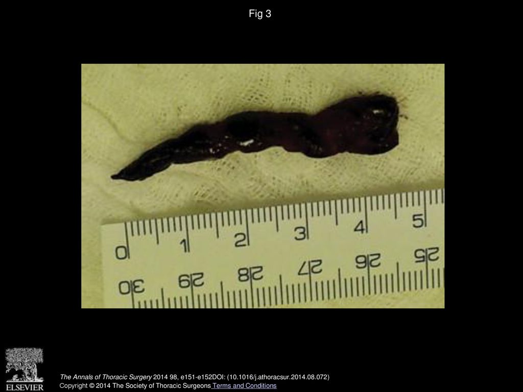Fig 3 Intraoperative image of intact wormlike thrombus removed from the patent foramen ovale.