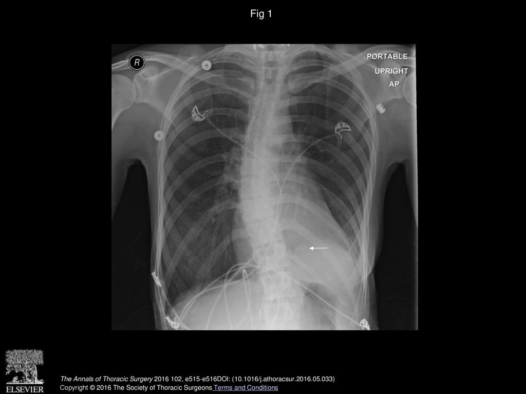 Fig 1 Chest radiograph demonstrating wire fragment (arrow) projecting from the myocardium.