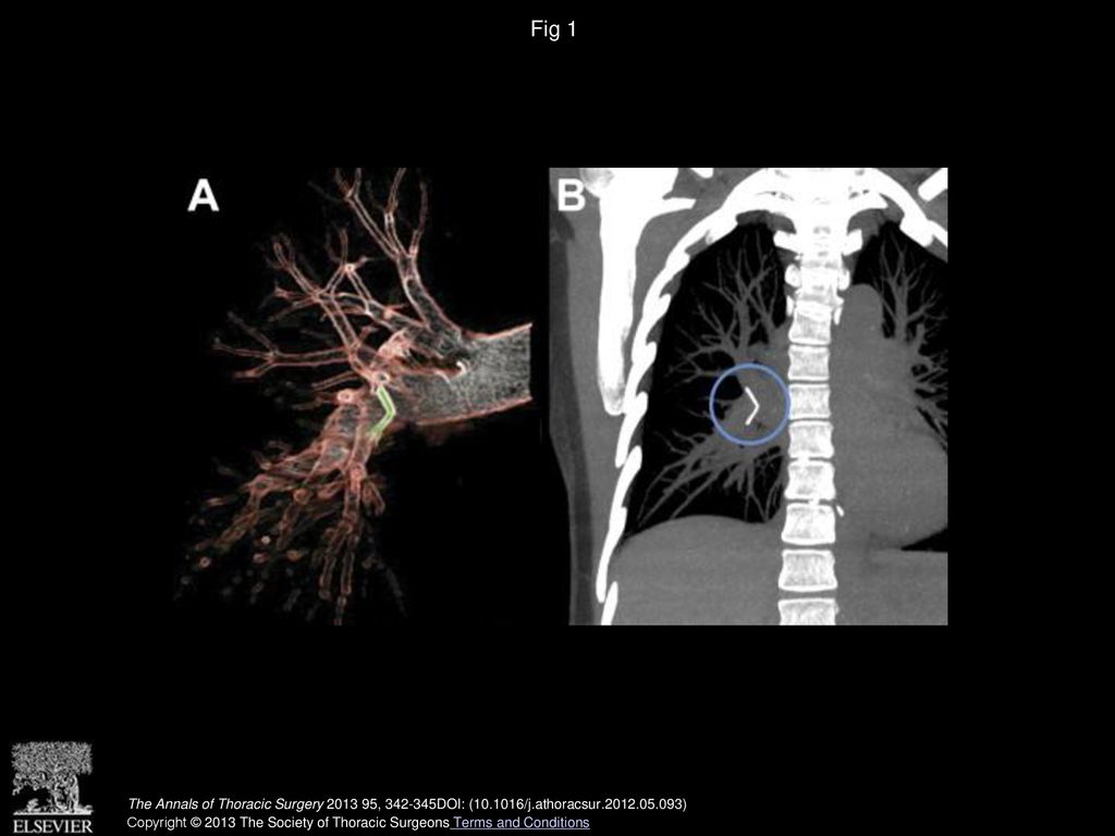 Fig 1 (A, B) Inferior vena cava filter (IVCF) in right middle lobe pulmonary artery. Circle highlights fractured IVCF fragment.