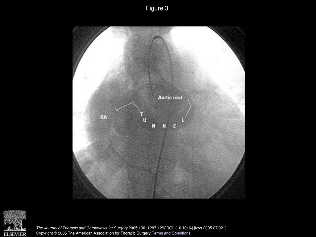 Figure 3 Posterior type of tunnel with normal coronaries, frontal view (patient 6). RA, Right atrium.