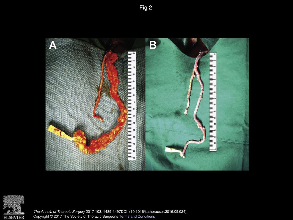 Fig 2 (A) No touch and (B) minimally manipulated saphenous vein composite grafts based on the in situ left internal thoracic artery.