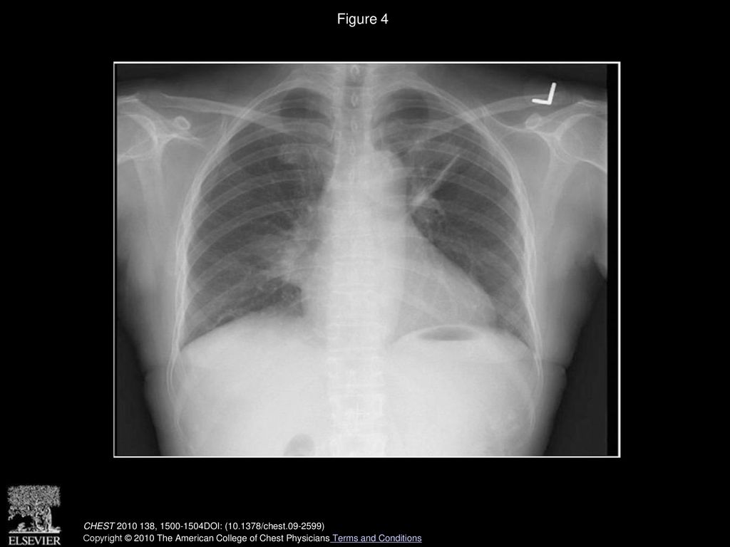 Figure 4 Chest radiograph done at 2 months, showing dramatic resolution of mass lesion following a course of prednisolone and cyclophosphamide.