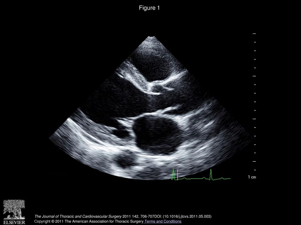 Figure 1 Transthoracic echocardiogram showing a long, loose membranous structure 10 mm above the right coronary annulus.