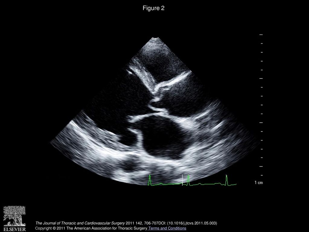 Figure 2 Transthoracic echocardiogram showing prolapse of a membranous structure into the left ventricular outflow tract during the diastolic phase.
