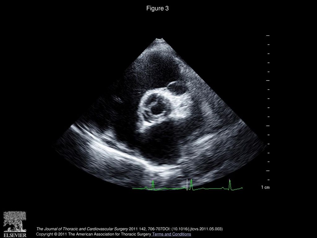Figure 3 Preoperative transthoracic echocardiogram of the annular intimal tear in short-axis view of the aorta.