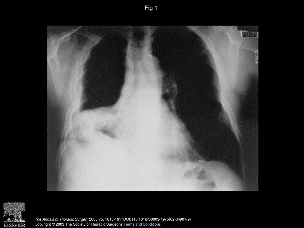 Fig 1 Preoperative chest radiograph of case 1 demonstrating a right-sided bronchopleural fistula.