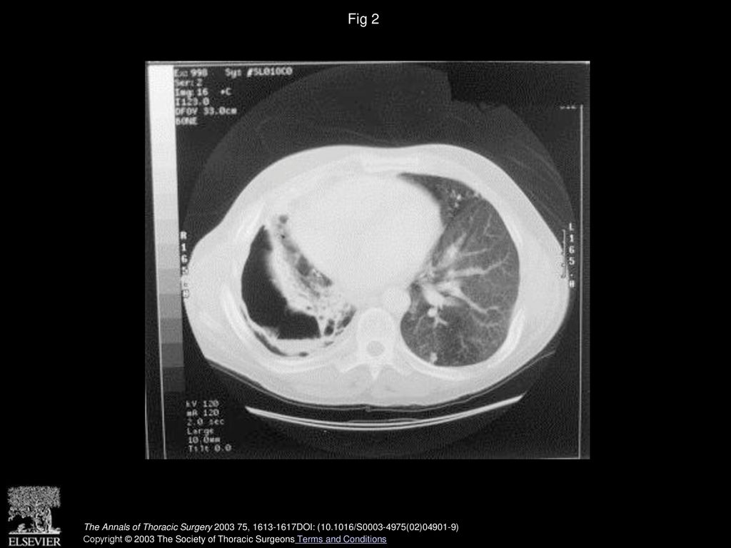 Fig 2 Preoperative chest computed tomographic scan of patient 1 demonstrating extensive right pulmonary cavitation.