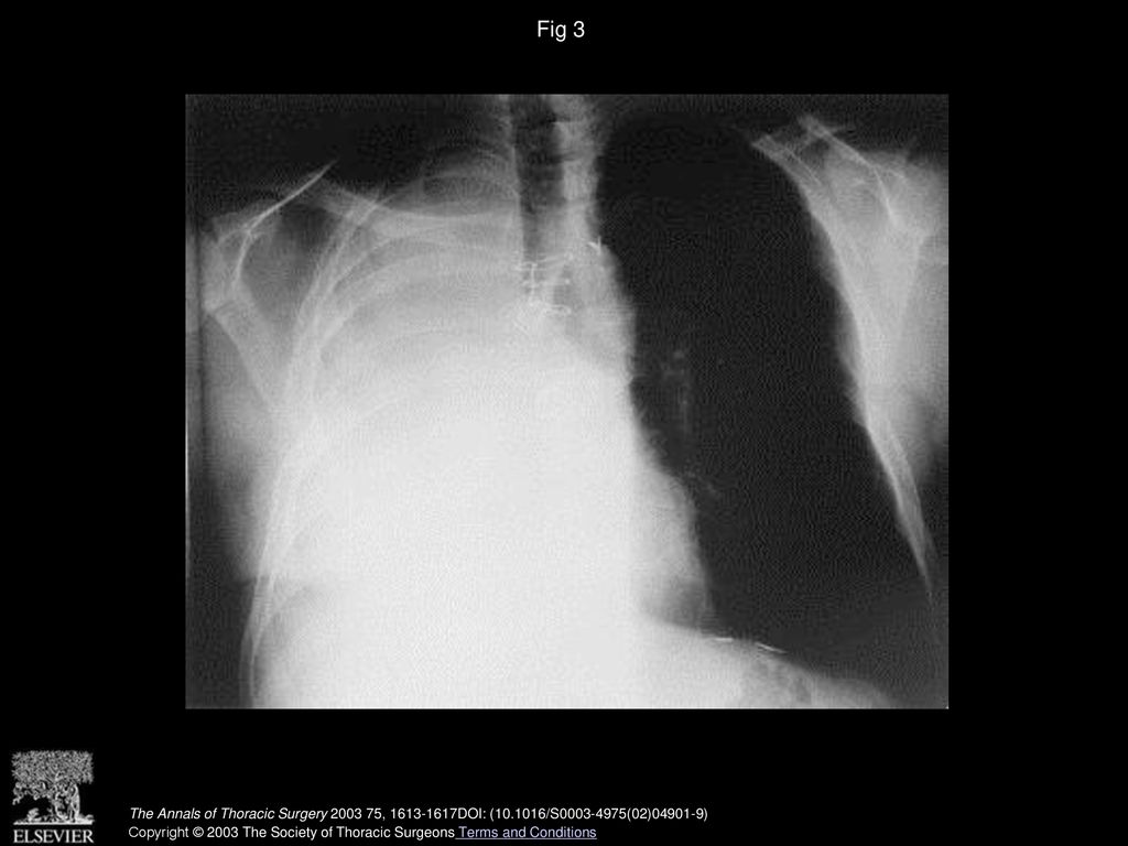 Fig 3 Postoperative chest radiograph of patient 1.