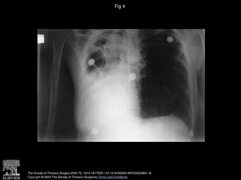 Fig 4 Preoperative chest radiograph of patient 5 revealing a destroyed right lung.