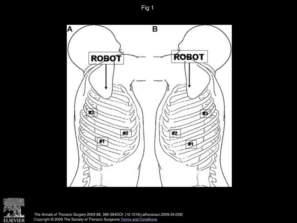 Fig 1 (A) Incisions (#1, #2, #3) and robot positioning, right side of chest. (B) Incisions (#1, #2, #3) and robot positioning, left side of chest.