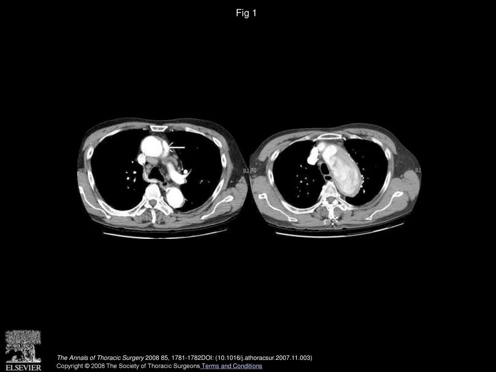 Fig 1 (Left) An intramural hemorrhage aortic dissection (arrow) at the aortic arch and (right) a proximal thoracic aortic aneurysm.