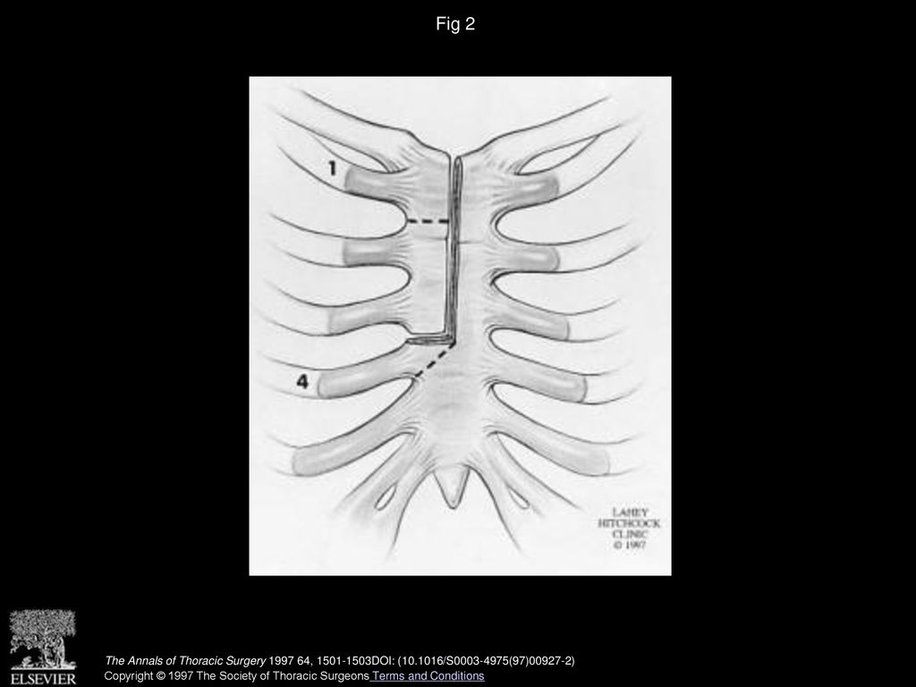 Fig 2 Sternal incisions. (© 1997 Lahey Hitchcock Clinic; reprinted with permission.)