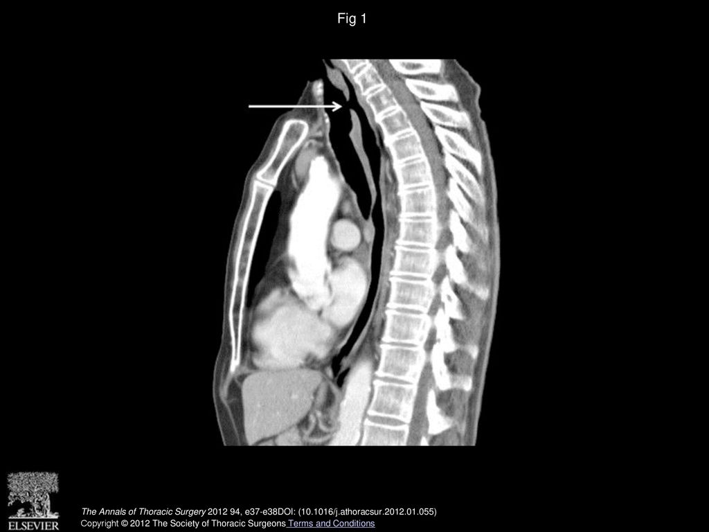Fig 1 Chest computed tomography demonstrating a 3 × 5 cm giant pharyngotracheal fistula, illustrated by the solid arrow.