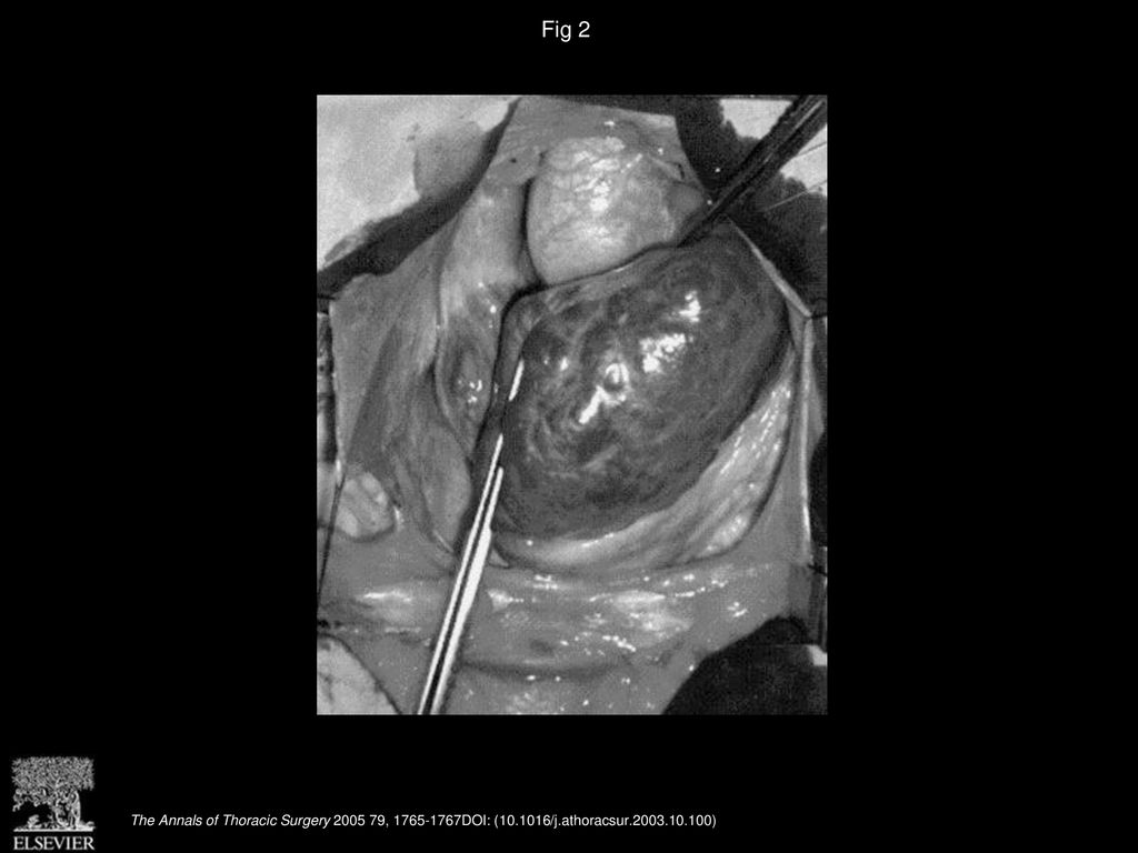 Fig 2 Large hemangioma completely overlying the right cardiac chamber.