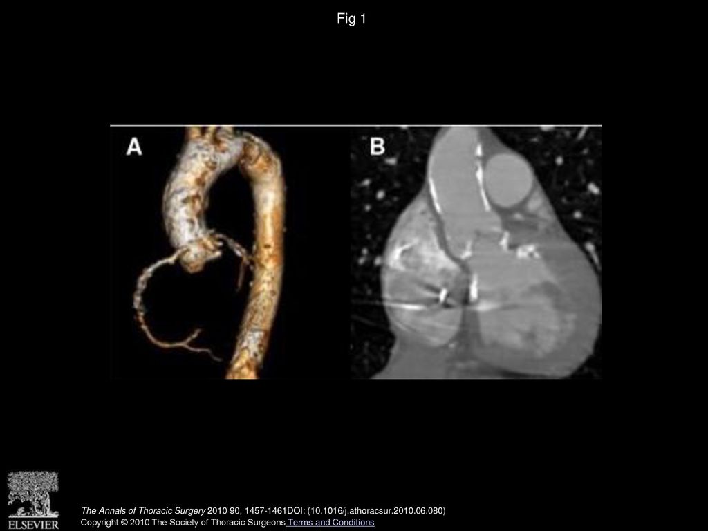Fig 1 Postoperative three-dimensional reconstruction (A) and computed tomographic scan (B) of porcelain aorta.