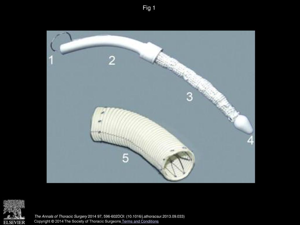Fig 1 The stent graft, Cronus. (1 = pull wire; 2 = handle; 3 = compressed state by a surgical thread; 4 = tip; 5 = released state.)