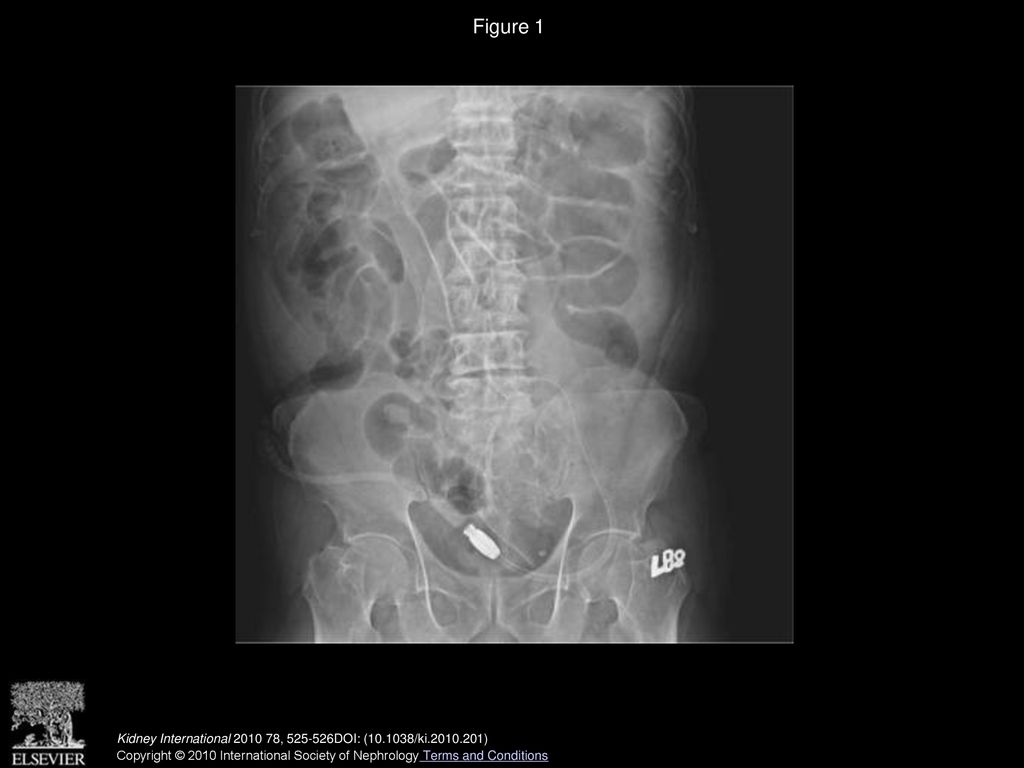Figure 1 Marked ileus and normal catheter tip position.