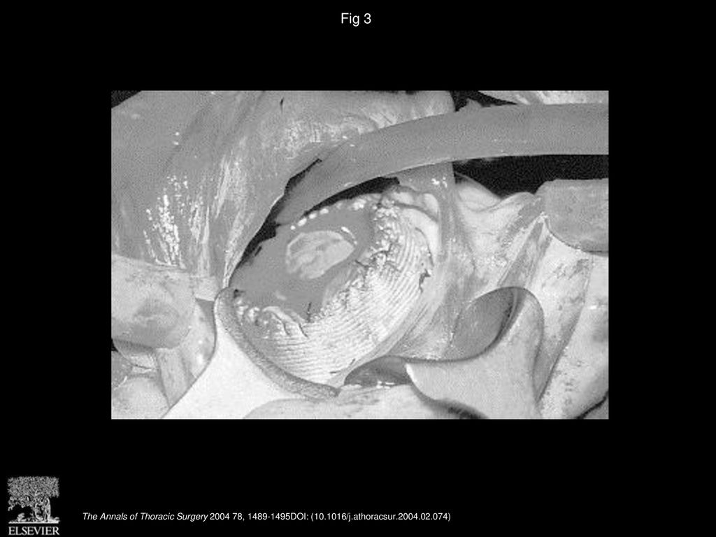 Fig 3 Autograft in the mitral position without pericardial collar (Kabbani modification).