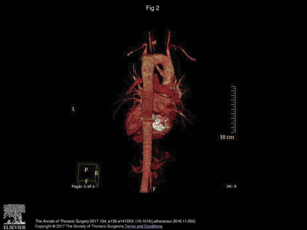 Fig 2 Posterior view of three-dimensional computed tomography scan of circumflex aortic arch.