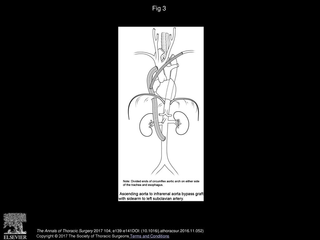 Fig 3 Schematic of ascending-to-descending aorta bypass with graft to left subclavian artery.