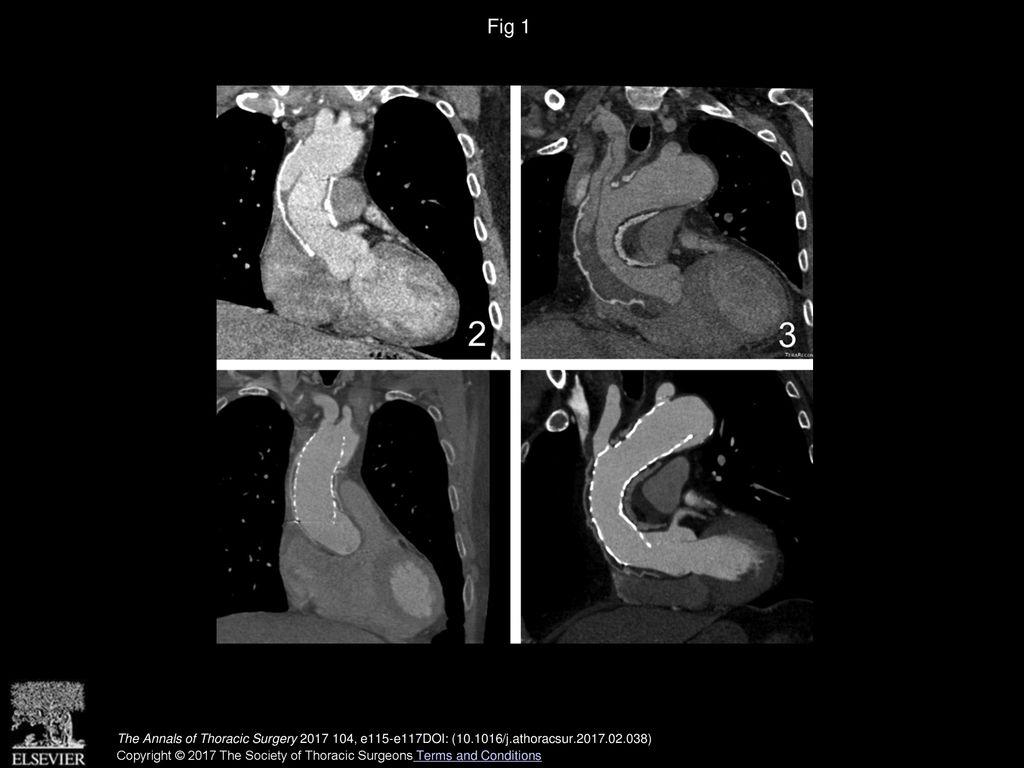 Fig 1 Aortic multi plan reconstruction (MPR) view of patients 2 and 3 (upper images) before and (bottom images) after stenting.