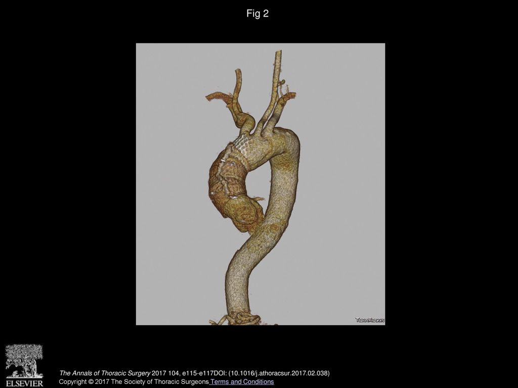 Fig 2 Three-dimensional reconstruction in patient 2. Ascending aortic stent in place after wrapping procedure.