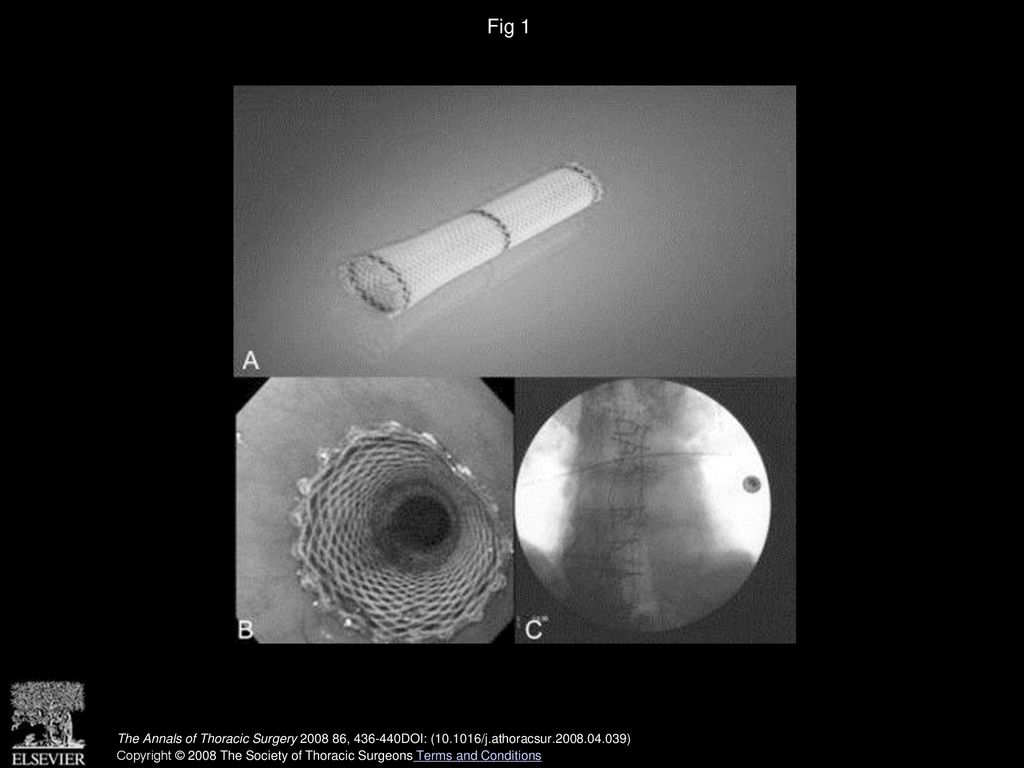 Fig 1 (A) The removable Polyflex silicone-covered esophageal stent. (B) Shown after endoscopic placement. (C) Fluoroscopic imaging.