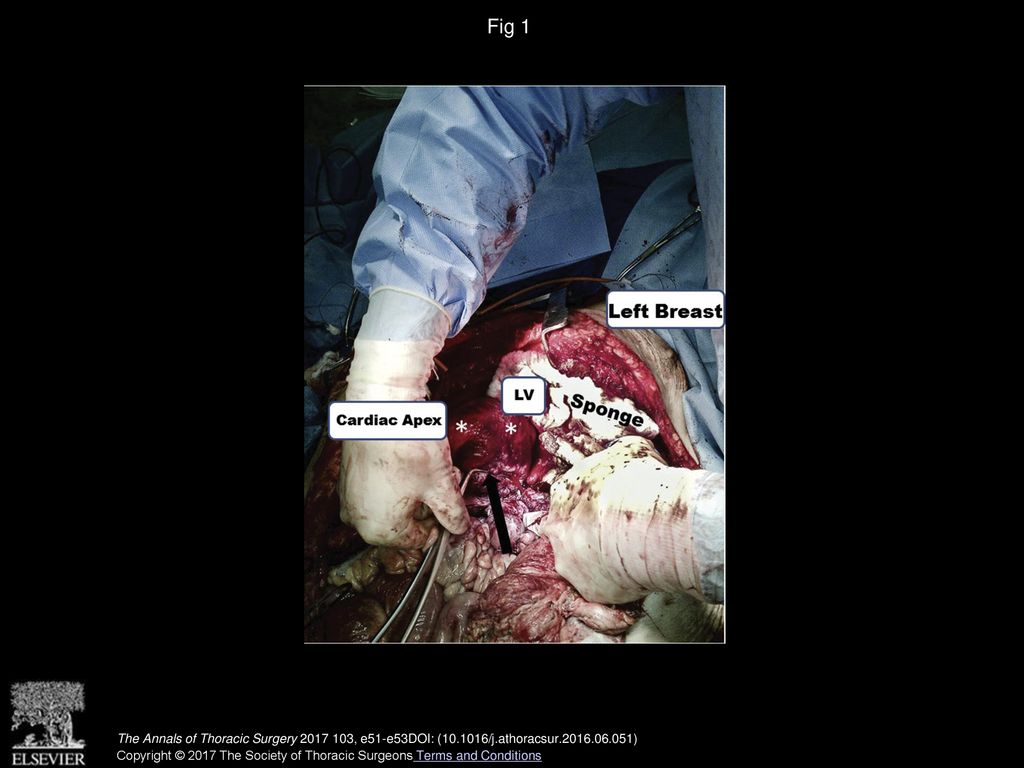Fig 1 Intraoperative photograph. The black arrow indicates the Satinsky clamp on the left ventricle (LV).