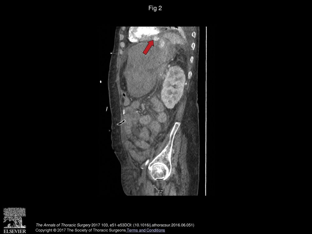 Fig 2 Computed tomography depicting contrast extravasation (red arrow).