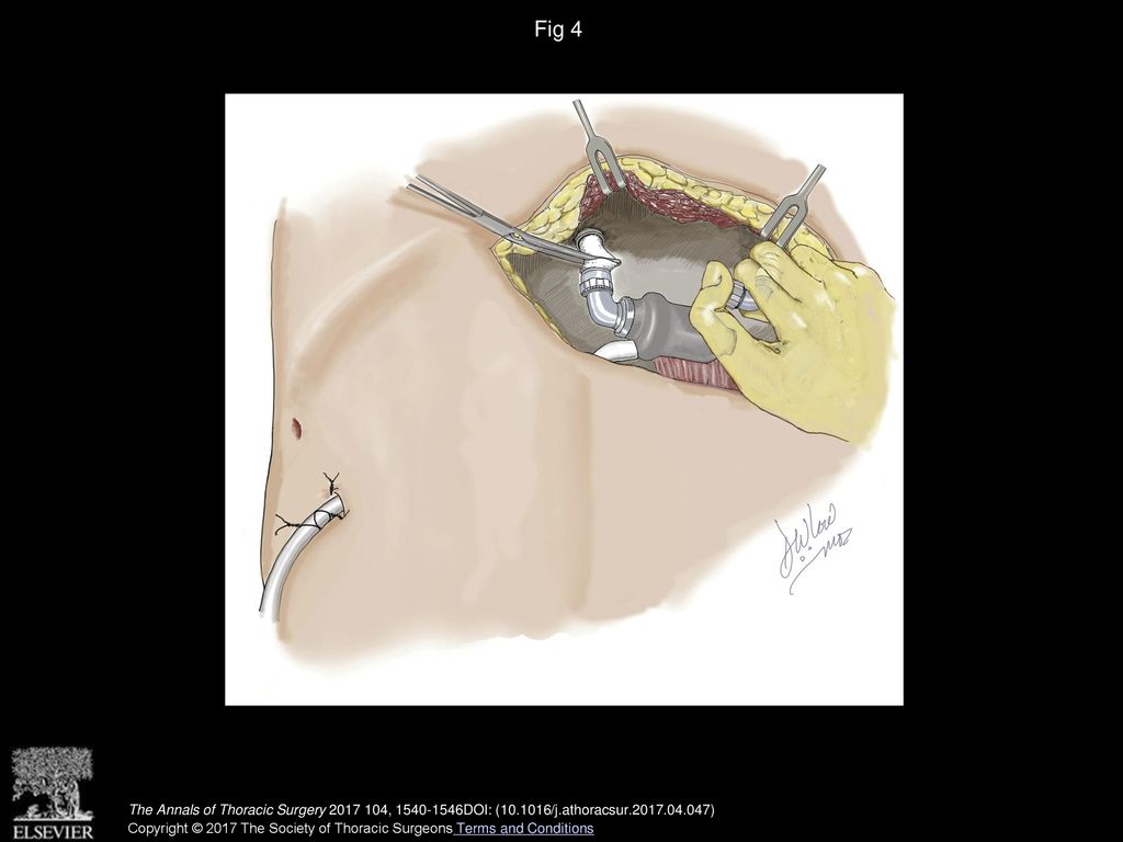 Fig 4 The outflow graft is connected to the new ventricular assist device.